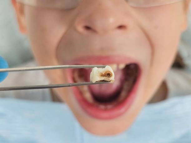 Best Emergency Wisdom Teeth Removal in Barclay, NJ